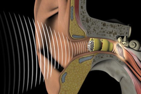 lyric-hearing-aid.jpg